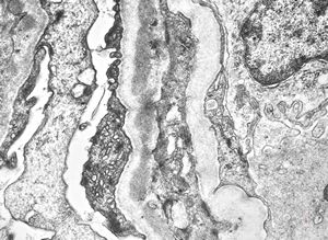 type I membranoproliferative glomerulonephritis type I membranoproliferative glomerulonephritis